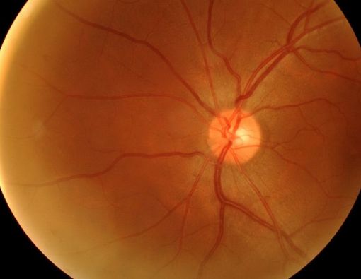 Awas, Obesitas Bisa Meningkatkan Risiko Retinopati Hipertensi