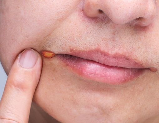 Mengenal Angular Cheilitis, Luka yang Muncul di Sudut Bibir