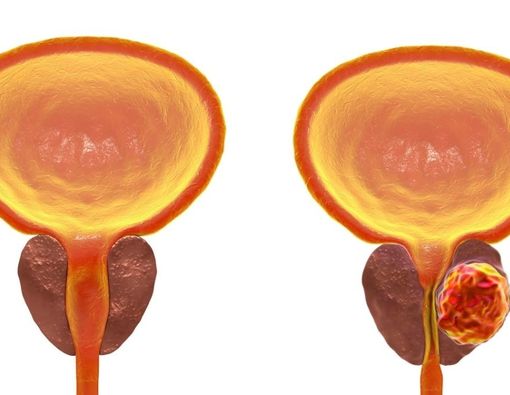 Seks Setelah Kanker Prostat, Kapan Bisa Dilakukan?