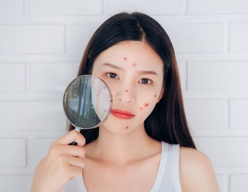 Cek di Sini Kondisi Jerawat yang Perlu Penanganan Dokter