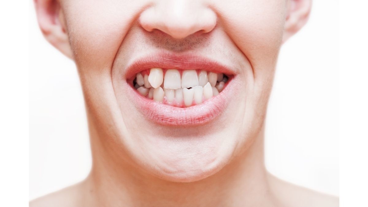 Ketahui Penyebab Gigi Gingsul, Apakah Berbahaya?