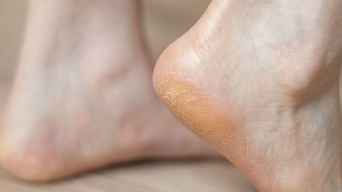 Tak Hanya Kulit Mengeras, Ini 4 Gejala Mata Ikan