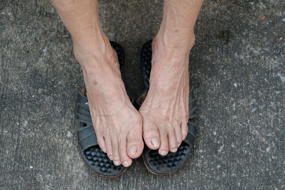 Kenali Gangguan Kesehatan pada Kaki Saat Lansia