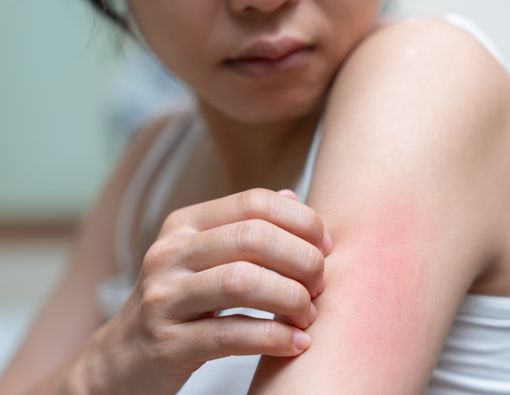 9 Penyakit Penyebab Kulit Gatal yang Tidak Boleh Disepelekan