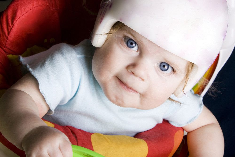 Flat Head Syndrome, Penyebab Kepala Bayi Datar