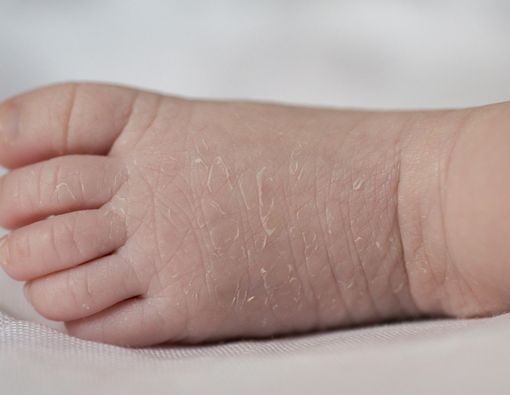 Bayi Gampang Sakit Kulit Akibat Terlalu Higienis?