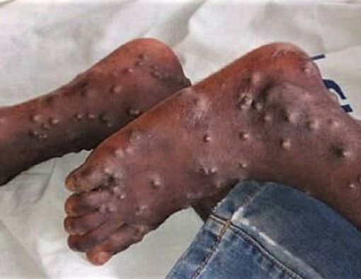 Ketahui Beda Cacar Monyet dan Cacar Air