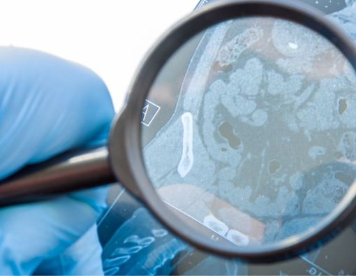 Benarkah Penyakit Crohn Bisa Picu Kanker? Ini Faktanya