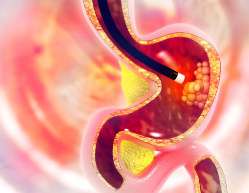 Prosedur Pemeriksaan Endoskopi yang Perlu Diketahui