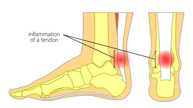 Tendinitis Achilles