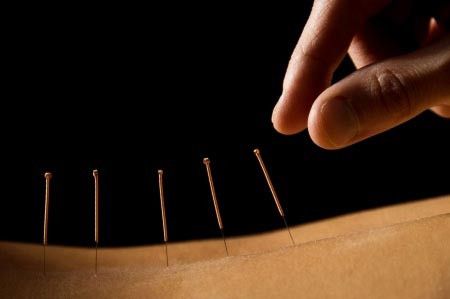 Chiropractic Vs Akupunktur: Mana yang Lebih Baik?