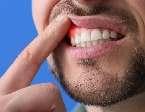 Apakah Vitamin C Bisa Menyembuhkan Gusi Bengkak?