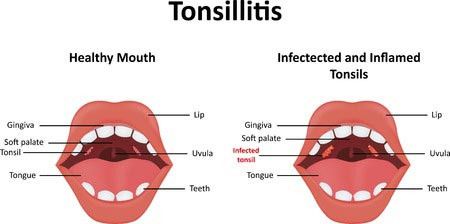 Apa Itu Tonsilitis?