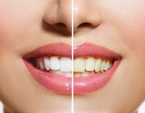 4 Cara Mudah Menjaga Gigi Putih Terawat