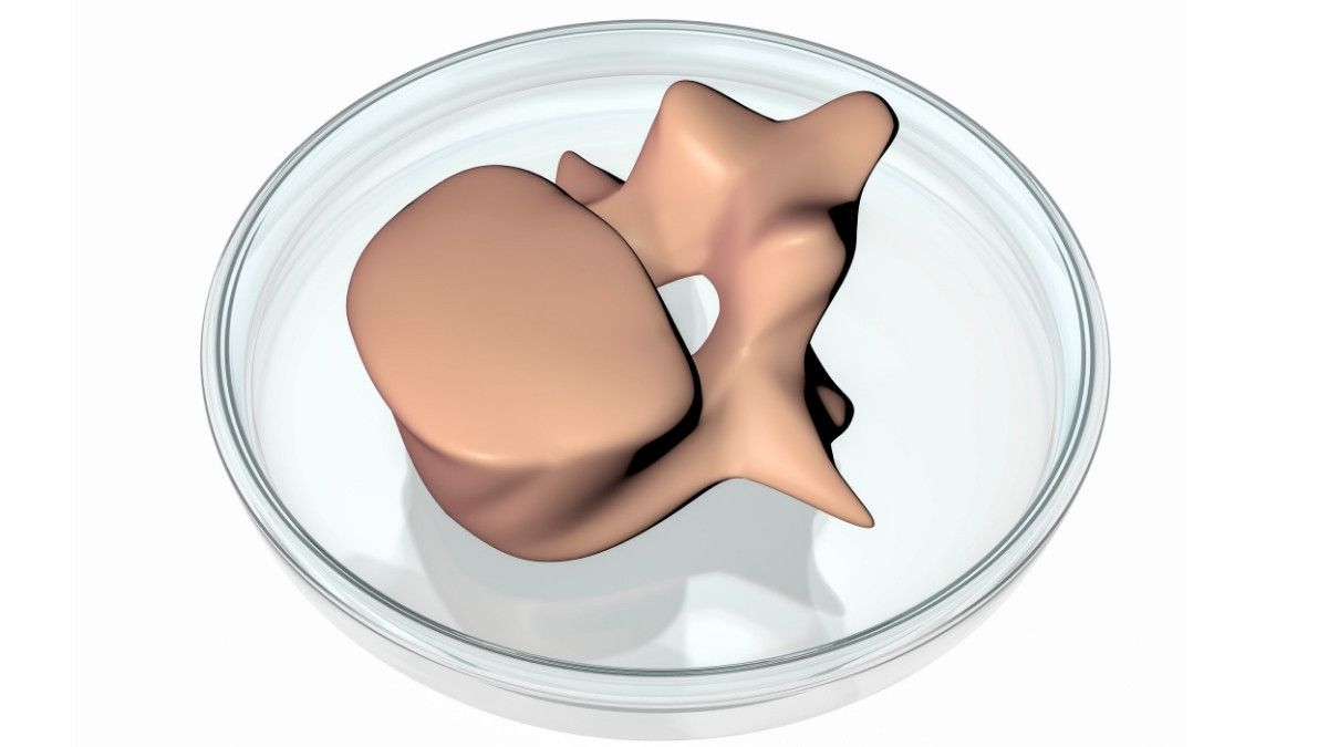 Mengenal Prosedur Pencakokan Tulang Lebih Dekat