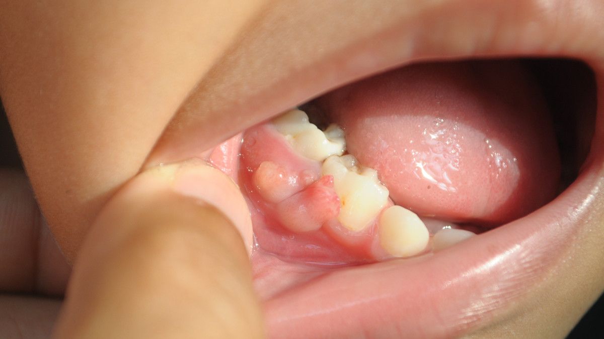 sakit gigi gusi bengkak pada anak apa obatnya 7