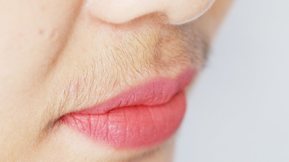 Waspada SAHA Syndrome, Pemicu Pertumbuhan Kumis pada Wanita