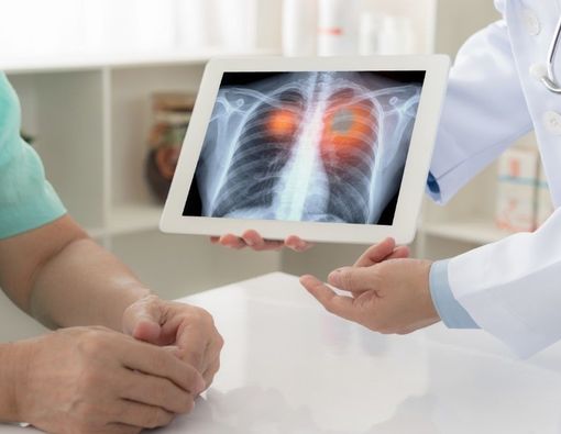 Alasan Transplantasi Paru Pasien Kanker Jarang Dilakukan