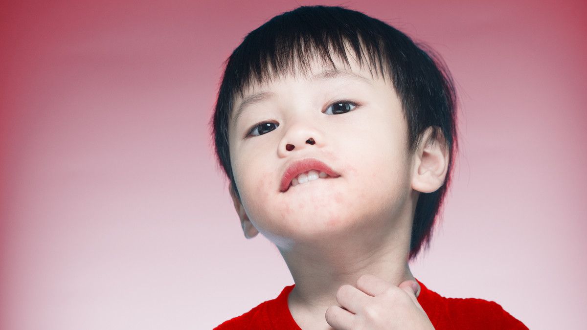 Alergi Susu Sapi, Apakah Anak Tidak Bisa Minum Susu Sama Sekali?