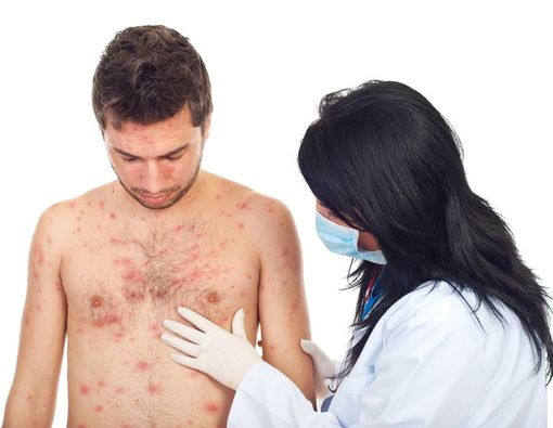 Kena Cacar Air Saat Dewasa, Berbahayakah?