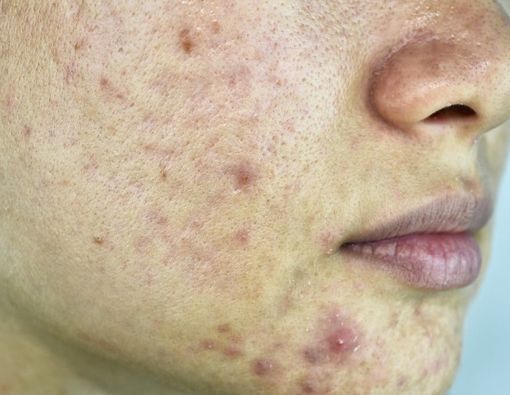 Mengenal Perbedaan Jerawat Purging dan Breakout