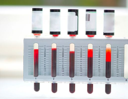 Hasil Laju Endap Darah (LED) Tinggi, Apakah Artinya Berbahaya?