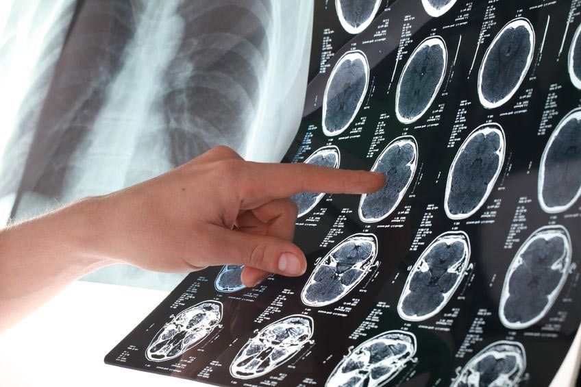 Sakit Kepala Biasa atau Akibat Tumor?