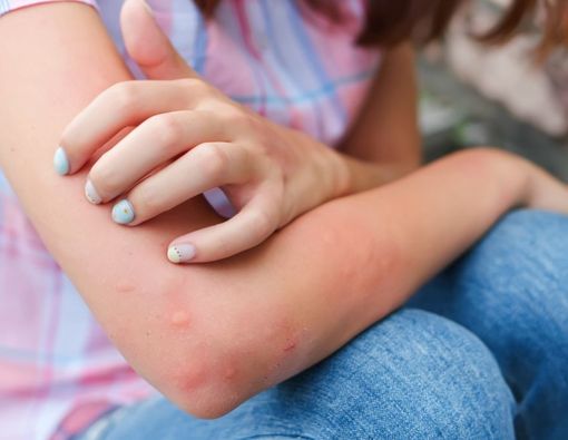 Kenali Berbagai Reaksi Gigitan Nyamuk pada Anda