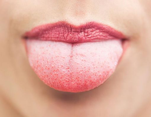 Benarkah Bercak Putih di Mulut Pertanda AIDS?