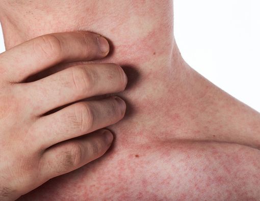 Kenali Gejala HIV lewat Kondisi Kulit