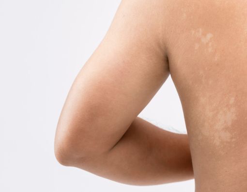 Awas, Panu yang Tidak Diobati Bisa Menyebabkan Komplikasi!