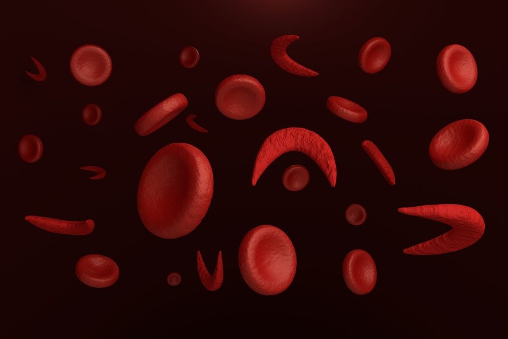 Mengenal Anemia Sel Sabit Lebih Dekat