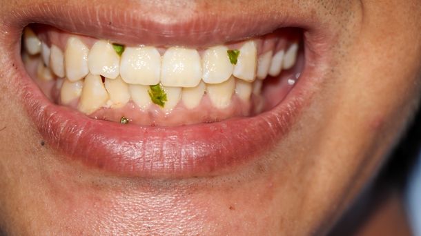 6 Bahaya Membiarkan Makanan Nyangkut di Gigi