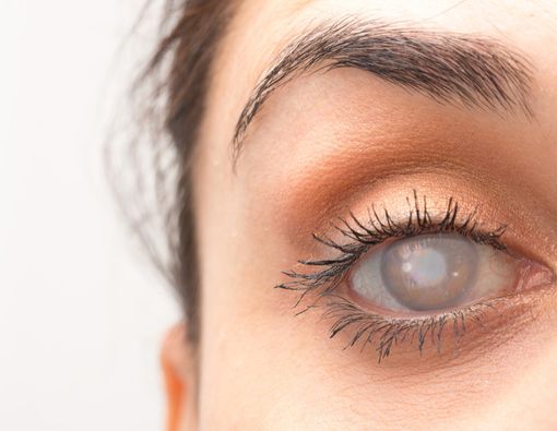 Catat! Ini Do’s and Don’ts Setelah Operasi Katarak