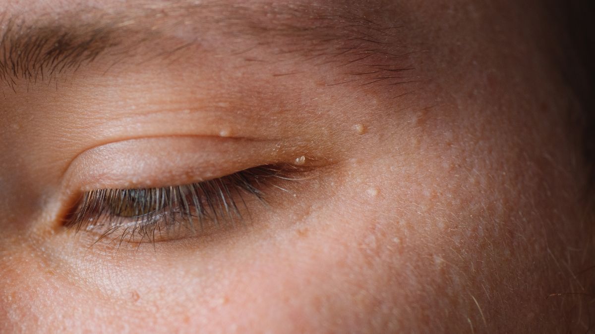 Ternyata, Ini 6 Penyebab Munculnya Milia