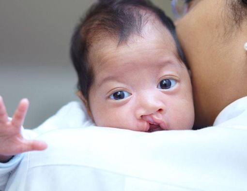Operasi Bibir Sumbing pada Bayi, Ini Persiapan dan Prosedurnya