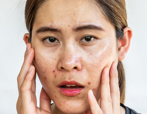 Terapi Topikal untuk Mengatasi Jerawat