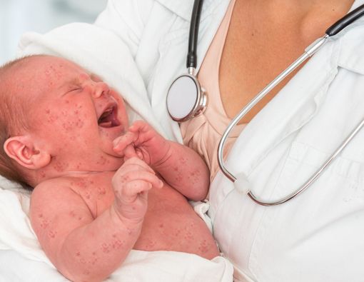 Mengenal Tanda-Tanda dan Gejala Herpes pada Bayi