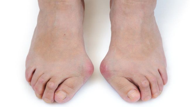 Menghilangkan Bunion Tanpa Operasi