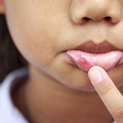 Sariawan Bisa Jadi Gejala HIV, Benarkah?