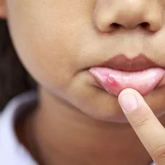 Sariawan Bisa Jadi Gejala HIV, Benarkah?