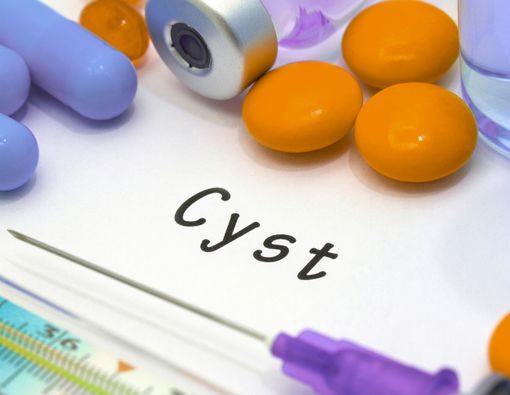 10 Penyebab Penyakit Kista yang Perlu Diwaspadai