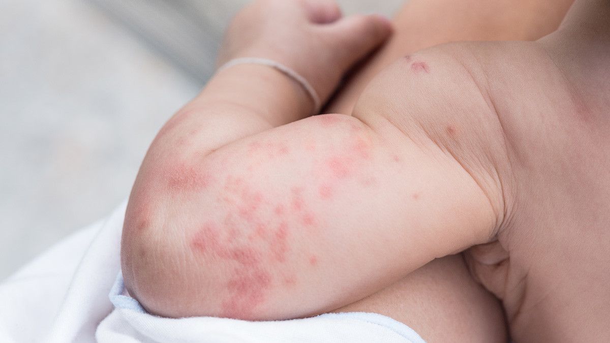 Alergi Susu Bikin Anak Biduran, Ini Solusinya