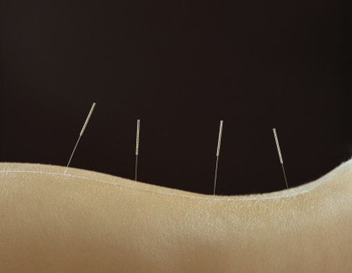 Atasi Ketakutan Terhadap Perawatan Gigi dengan Terapi Akupunktur