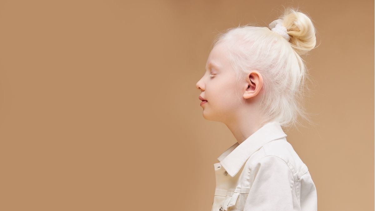 Cara Menjaga Kesehatan Mental Anak Albino