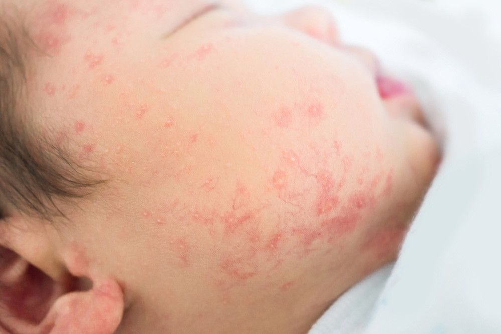 Ruam Merah pada Bayi, Apakah Tanda Alergi? (Tongo51/Shutterstock)