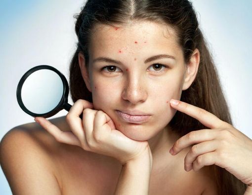 Cara Aman Memencet Jerawat Agar Tidak Iritasi