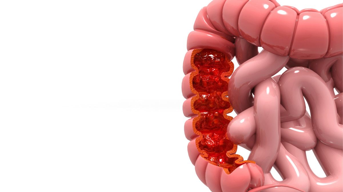 Ilustrasi Kanker Usus Besar (Foto: Shutterstock)