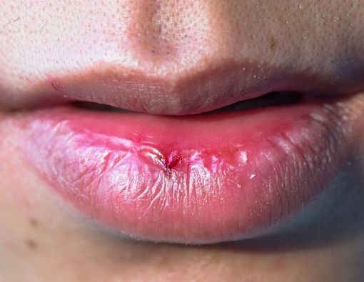 Tanda dan Gejala Kanker Bibir yang Mesti Anda Waspadai