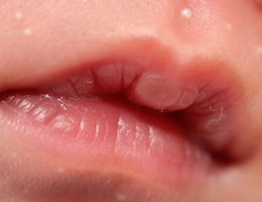 Mengenal Kondisi Lip Blister atau Suck Blister pada Bayi